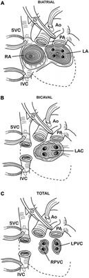 Diastolic function in heart transplant: From physiology to echocardiographic assessment and prognosis